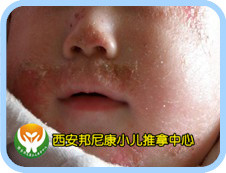 小儿推拿手法治疗湿热性湿疹的配穴:清脾经,清胃经,清大肠,清小肠