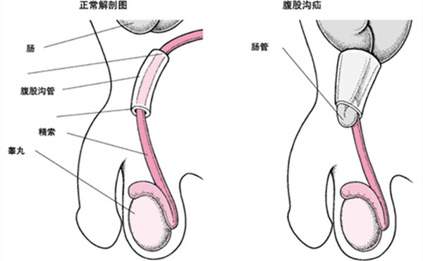 疝气百科宝宝小肠气什么时候手术最好