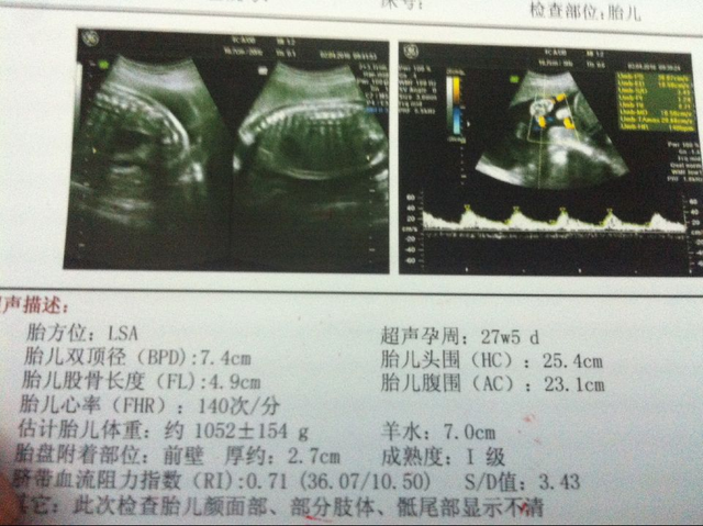 胎方位lsa什麼意思啊