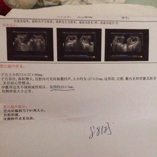 b超看胎儿性别图解_b超怎么看胎儿性别