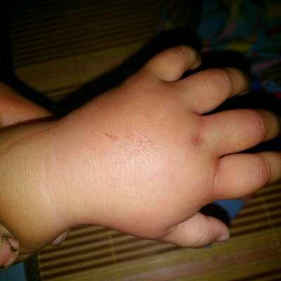 宝宝的手不知道被什么咬了肿的很厉害