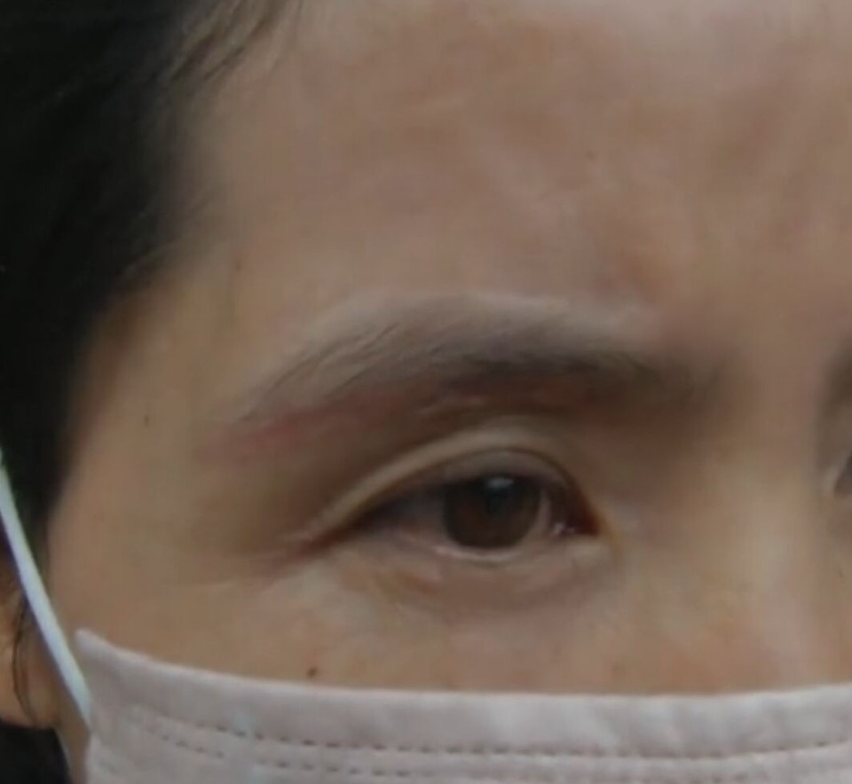 切眉手术后老得快是副作用的原因吗?答案你绝对想不到