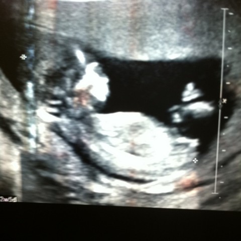11 13周超声波看男女 宝宝树