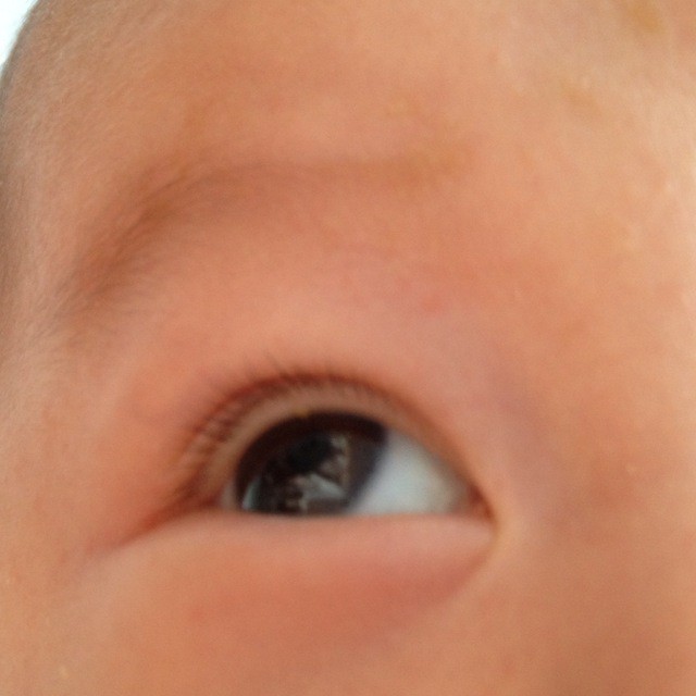 宝宝上眼皮经常起小水泡,怎麼回事呢?如图