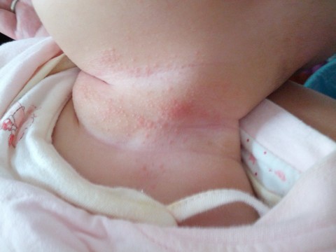 原来宝宝脖子里起的是不是湿疹 是间擦疹 宝宝树 原来宝宝脖子里起的是不是湿疹 是间擦疹 宝宝树