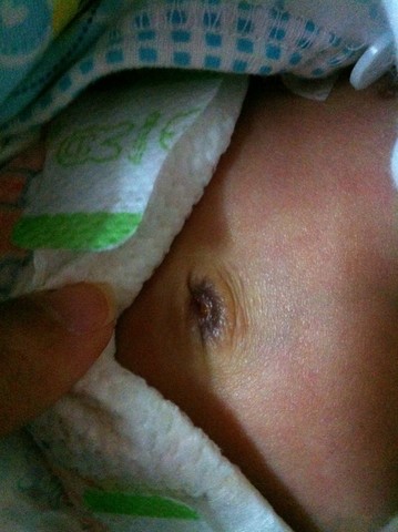 1岁宝宝正常肚脐照片图片