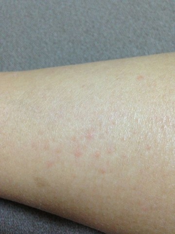这是湿疹吗 痒的受不了 胳膊腿上都有 怎么办啊 宝宝树
