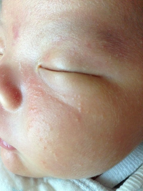 宝宝脸上长小米粒图片
