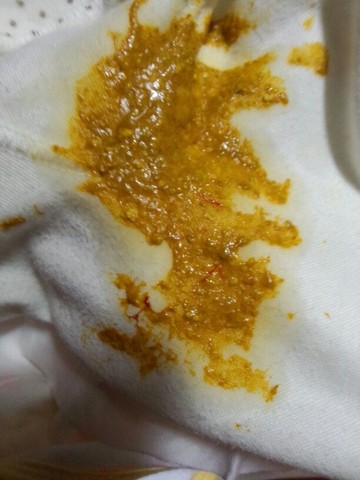 两个多月开始便血,吃了蒙脱石好了几天又开始便血,后来诊断为痢疾吃药