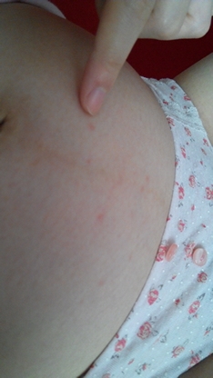 23周肚皮开始起小红点是神马情况 不会是妊娠纹初期吧 啊哦 宝宝树