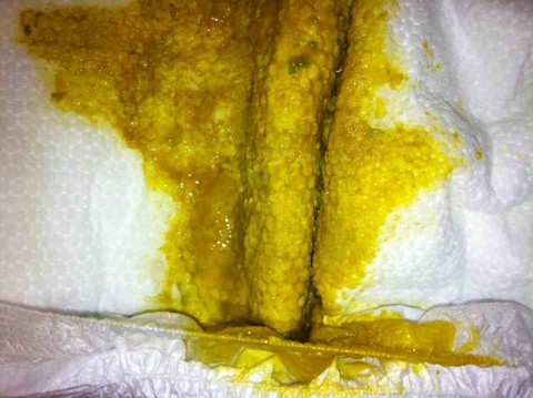 宝宝拉肚子怎麼办