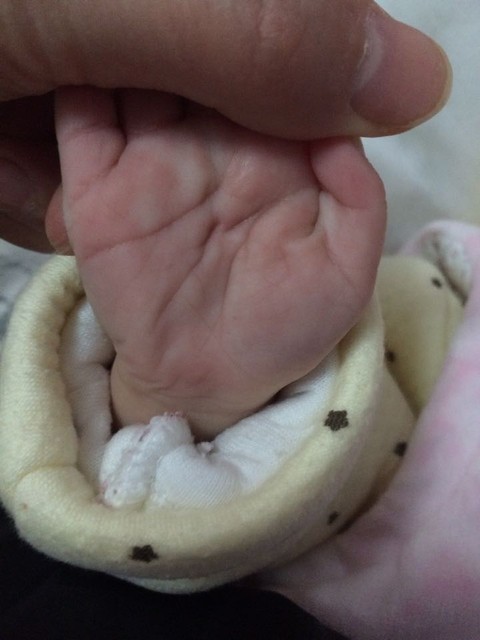 新生儿双手通贯掌图图片