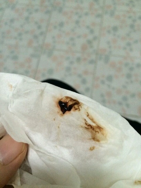 求助25周又见黑色分泌物,怎么办啊?