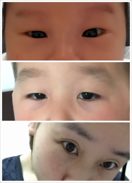 刚做的双眼皮.好疼啊._也不知道几天能消啊._宝宝树