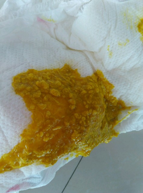 拉奶瓣屎,有酸臭味,求解决方法!