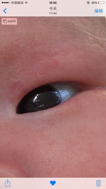 正常的新生儿眼球图片图片