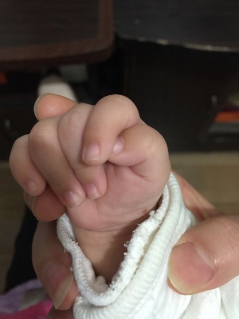 宝宝三个月 每个指甲有条白杠 有点凸出