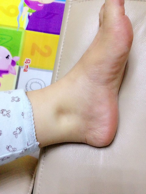 5.28现在全身肿的不成样子了