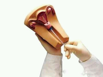 精女性上环后同房不能太频密?关於上环你不知道的事!