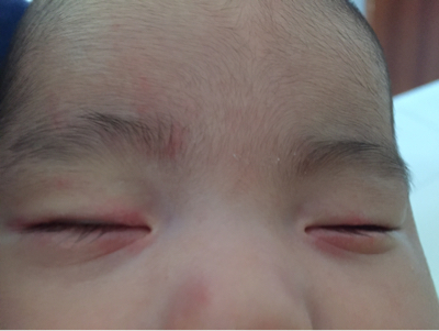宝宝下眼睑折痕图片图片
