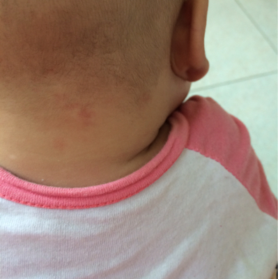 我家宝宝3个月了2个多月的时候发现脖子后面有个绿豆大的白色点,这不