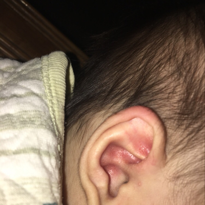 宝宝耳廓红肿图片图片