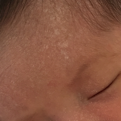 婴儿脖子汗疱疹图片