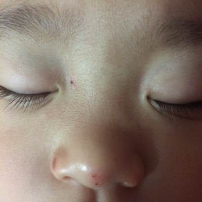 仅有的宝宝:鼻子上长的小黑点,什麼东西