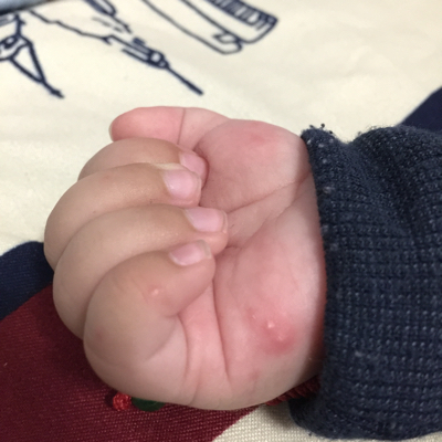 宝宝手上长痘痘怎麼回事