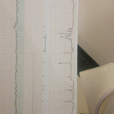 今天做产检胎监,医生说缺氧,后来吊针高氧注射,再做输氧,又重新做一次