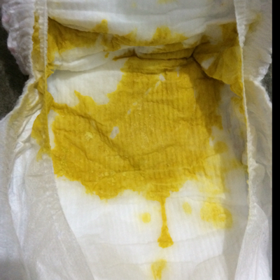 宝宝五十多天,前两天着凉吐奶轻微胃胀,而且最近一段时间大便几天一次