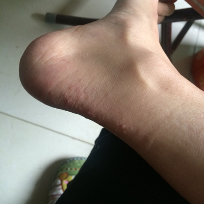 晕32周,最近晚上睡觉时,脚一热脚后跟就痒的很,请问这是怎麼了