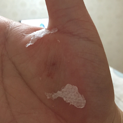 怀孕7个半月,手掌被玻璃渣扎伤,可以肯定的是玻璃渣没进到手掌肉里,用