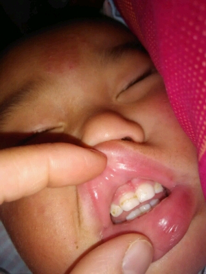 宝宝门牙上有洞眼图片