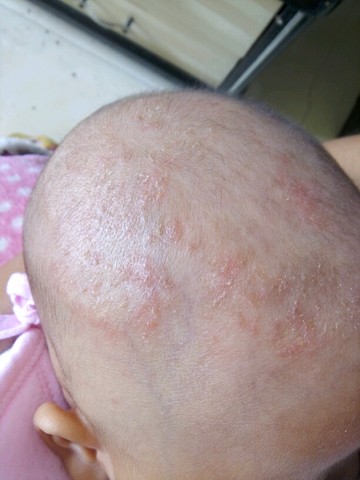 婴儿头皮上有红斑图片图片