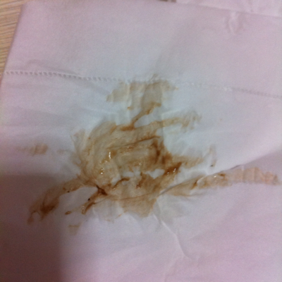 问答 怀孕期 推荐回答                     你好,你这种情况应该卧床