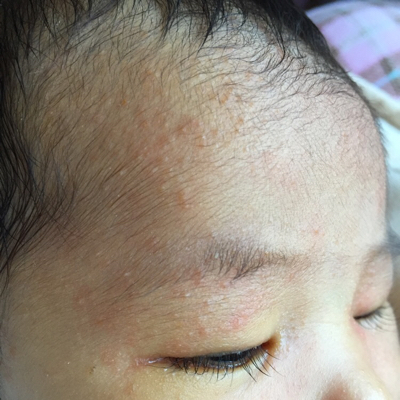 我家宝宝今天31天了,黄疸不但没退,这几天脸上又长了好多红的小点点
