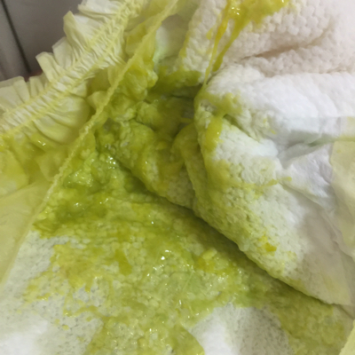 就吐了一次,量很多.然后醒来拉大便是浅绿色的带白色奶瓣.