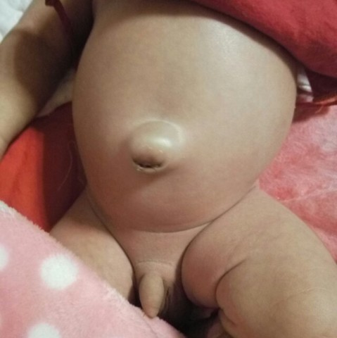 我家的也是脐疝   用了一段时间松紧带没见好   上几天在网上买个脐疝