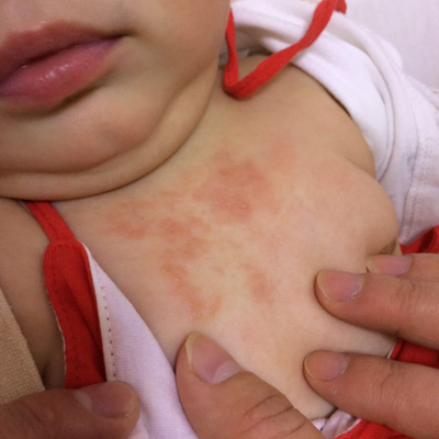 婴儿胸口红疹图片图片