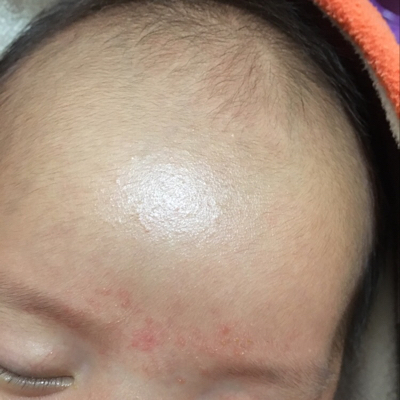 宝宝额头上有红斑图片图片