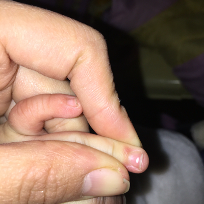 宝宝缺锌指甲白斑图片图片