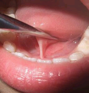 婴幼儿舌头下面的图片图片