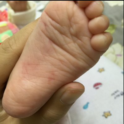 宝宝两个半月脚有红印是怎麼回事