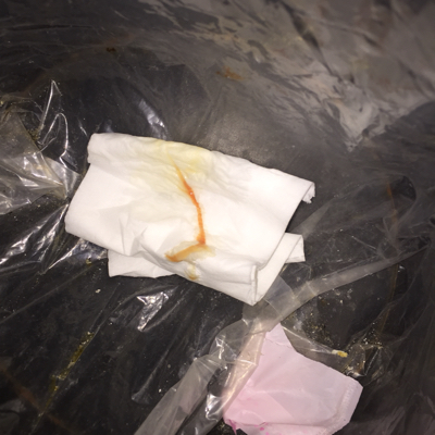 怀孕一个月白带出血了,严重吗?