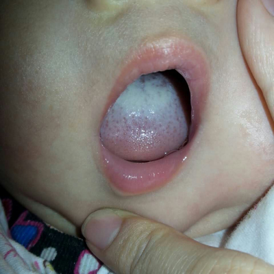 我家宝宝快6个月了,舌苔厚怎麼回事啊?
