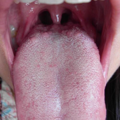 舌头丝状疣图片