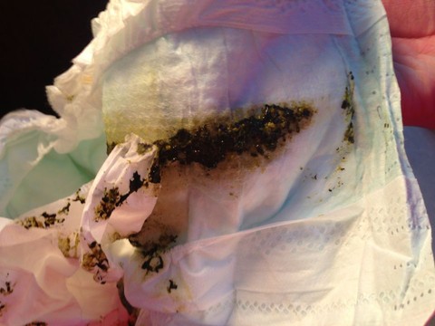 帮忙看下小孩拉这种大便是为什么?有图甚入