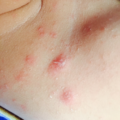 宝宝身上不断起红包,红点,找不到原因,急