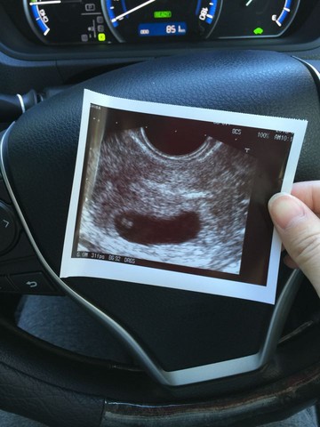 怀孕圆形孕囊图片图片